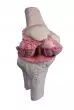 Modello di protesi del ginocchio Erler Zimmer 1125