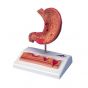 Modello di stomaco con ulcere gastriche K17