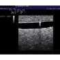 Simulatore per scleroterapia guidata da ultrasuoni per vene varicose P60 3B Scientific