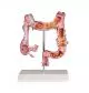 Modello dell'intestino con patologie Erler Zimmer K285