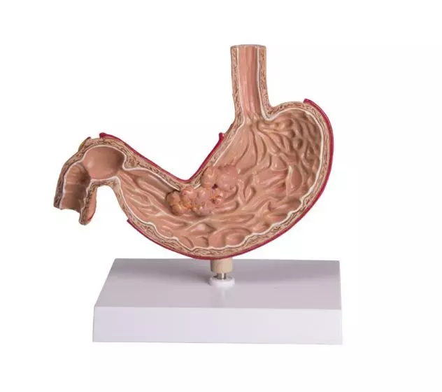 Modello anatomico di stomaco umano con cancro K83 Erler Zimmer