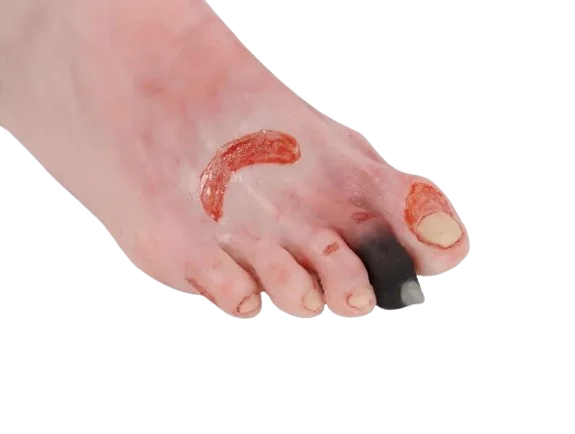 Modello Erler Zimmer di piede leso con sindrome del piede diabetico