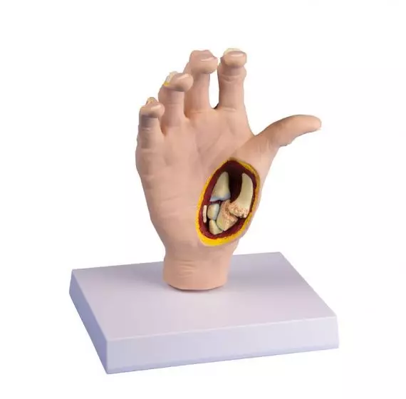 Modello anatomico della mano con artrosi M25 Erler Zimmer