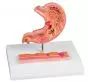 Modello dello stomaco umano con ulcere gastriche Erler Zimmer K217