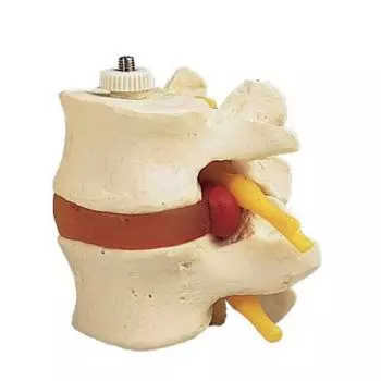 Modello di 2 vertebre lombari con ernia del disco, montaggio elastico A76/9