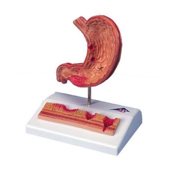 Modello di stomaco con ulcere gastriche K17