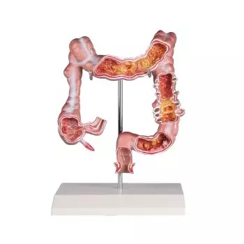 Modello dell'intestino con patologie Erler Zimmer K285