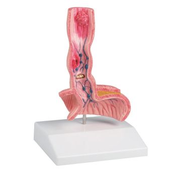 Modello dell'esofago umano con patologie Erler Zimmer K218