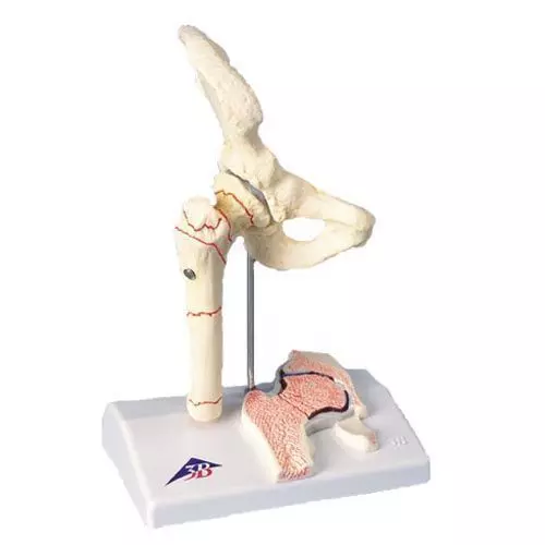 Modello di Frattura del femore e lussazione dell’anca A88