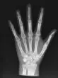 Fantasma radiografico dell'avambraccio Erler Zimmer