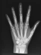 Fantasma radiografico della mano Erler Zimmer