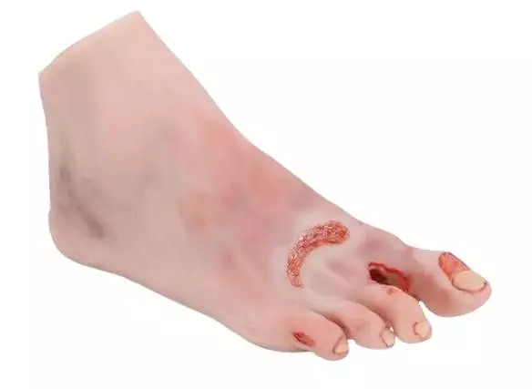 Modello anatomico Erler Zimmer del piede diabetico grave