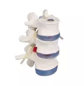 Modello di vertebre lombari con ernia al disco 4048 Erler Zimmer