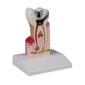 Modello di molare con carie, ingrandito 10 volte - D214 Erler Zimmer