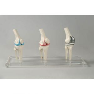 Modello di protesi del ginocchio Erler Zimmer 1125