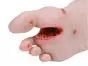 Modello anatomico Erler Zimmer del piede diabetico grave