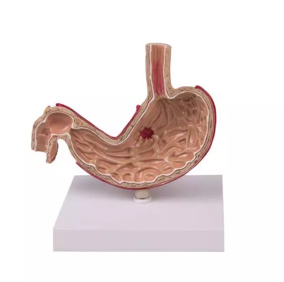 Modello anatomico di stomaco con ulcera K80 Erler Zimmer