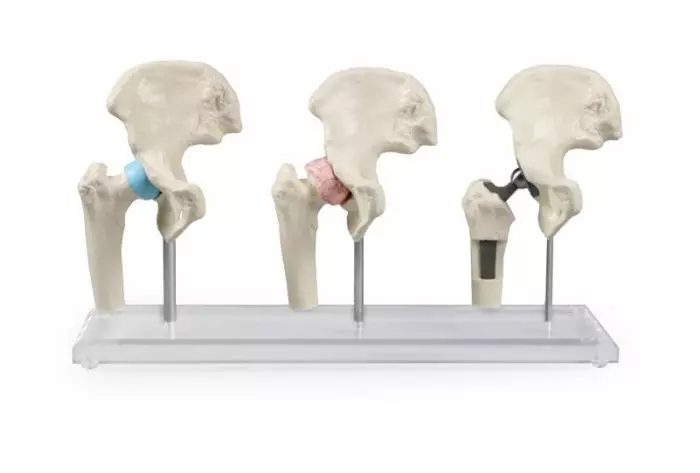 Modello di protesi dell' anca Erler Zimmer 1115