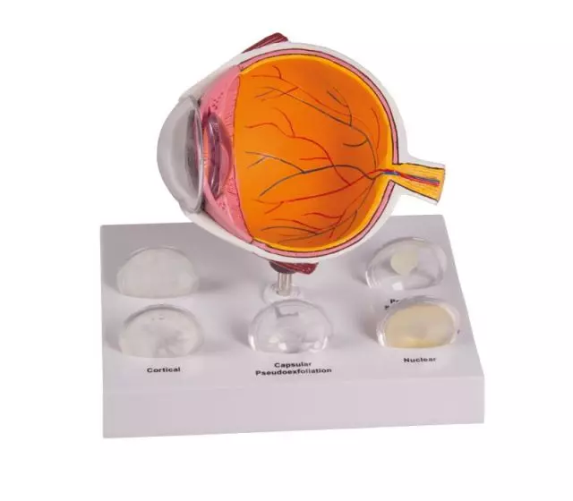 Modello anatomico di occhio con cataratta F80 Erler Zimmer 